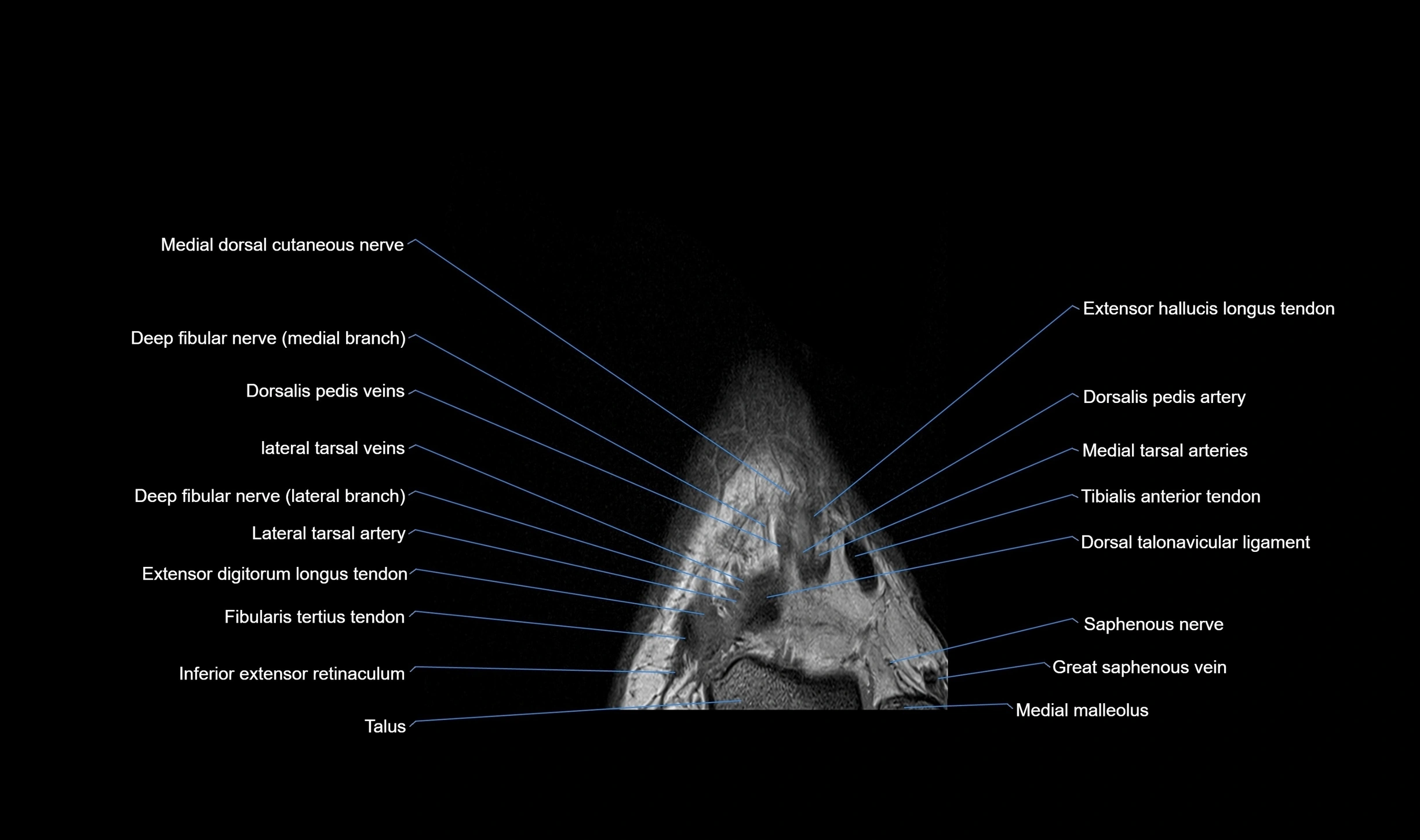 MRI mid foot coronal ligaments cross sectional anatomy 3T  radiology  image-img-00001-00008.webp